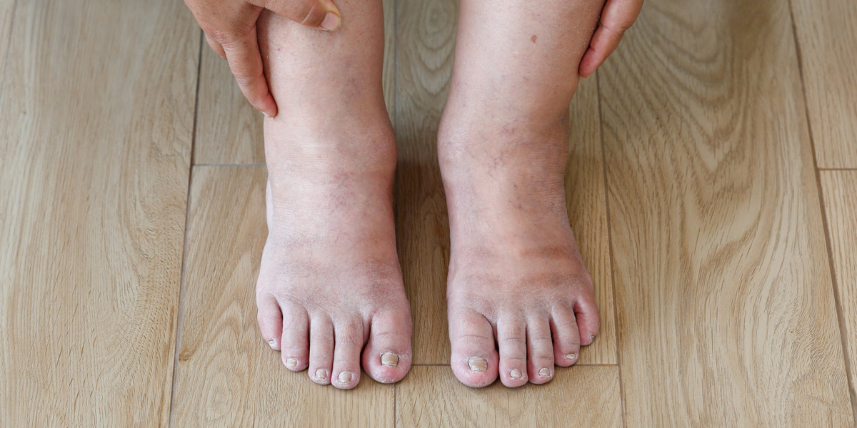 تورم دست‌ها یا پاها یکی دیگر از علائم این بیماری است.