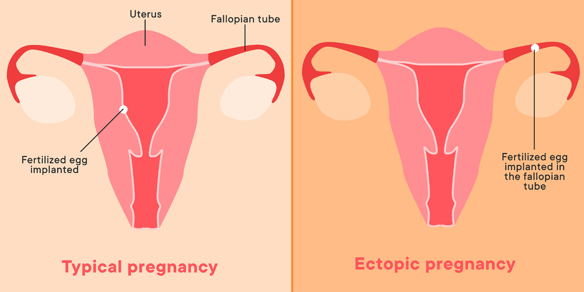 در بارداری طبیعی تخم بارورشده درون رحم قرار می‌گیرد، ولی در حاملگی خارج از رحم تخم بارورشده در لوله‌های منتهی به رحم لانه گزینی می‌کند.