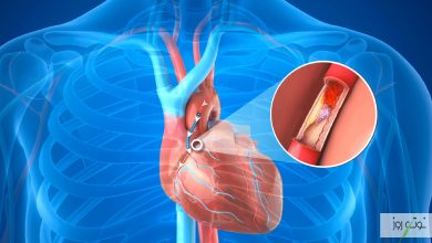گرفتگی رگ قلب چیست و چه روش هایی برای درمان آن انجام می‌شود؟