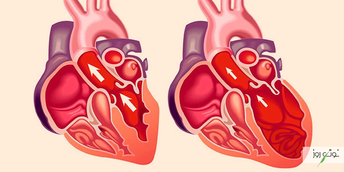 انسداد جریان خون یکی از عوارض بیماری ضخیم شدن دیواره قلب به شمار می‌آید.