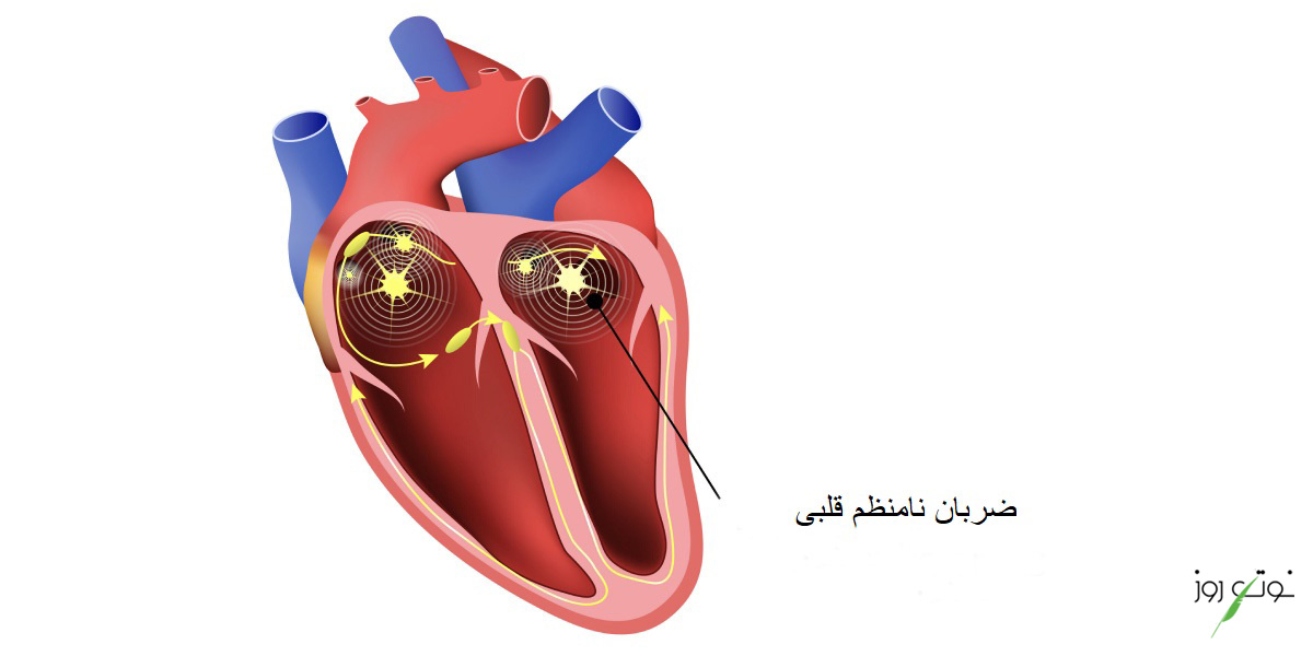 آریتمی قلب به معنای نامنظم شدن ضربان قلب است.