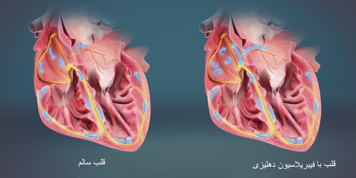 آریتمی قلب در صورت تشدید ممکن است موجب مرگ شود.