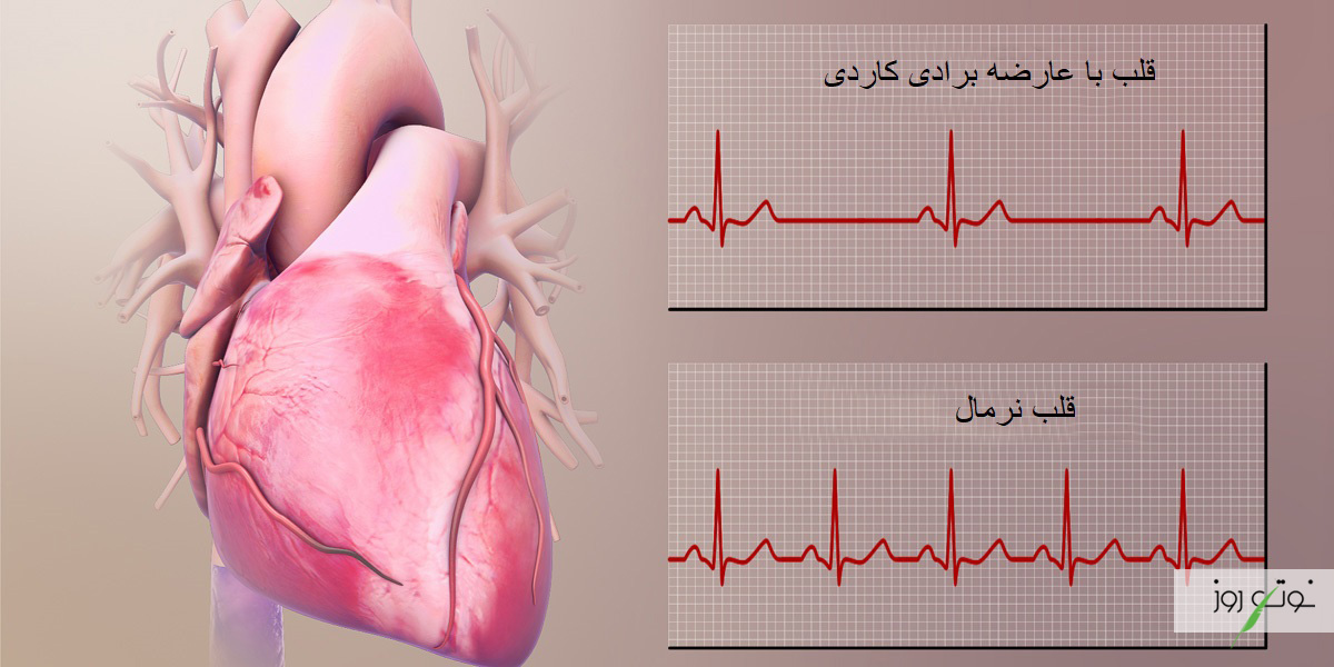 درمان آریتمی قلب به شدت و نوع بیماری بستگی دارد.